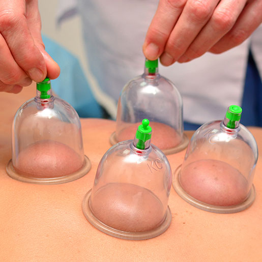 Cupping at Brown Chiropractic increases circulation and promotes soft tissue healing.
